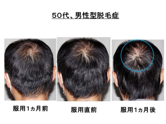 円形脱毛症　病院